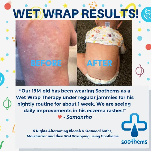 "Eczema Sleeves for Kids – Arm & Leg Sleeves for Wet Wrap Therapy & Eczema Relief"