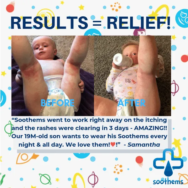 "Eczema Sleeves for Kids – Arm & Leg Sleeves for Wet Wrap Therapy & Eczema Relief"